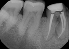After treatment - Root Canal Retreatment #30