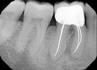 Before treatment - Root Canal Retreatment #30
