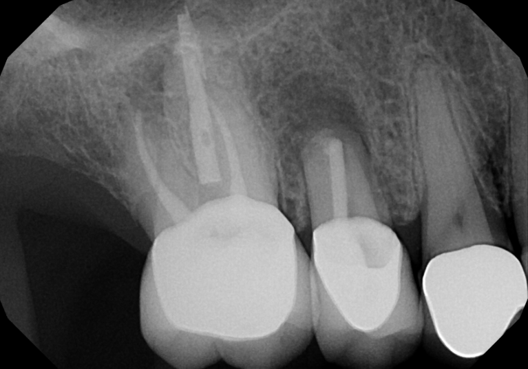 After treatment - Endodontic Surgery (Apicoectomies) #4