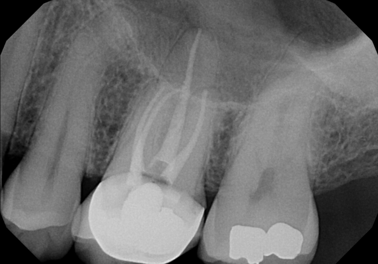 After treatment - Root Canal Treatment #14