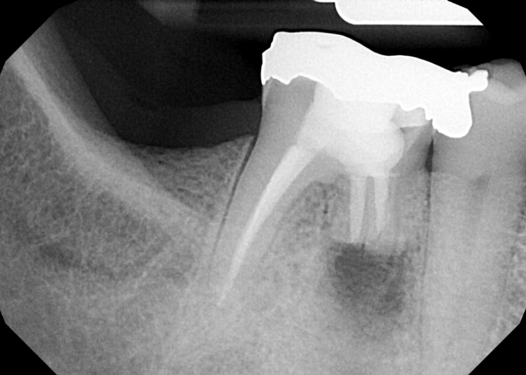 After treatment - Endodontic Surgery (Apicoectomies) #30