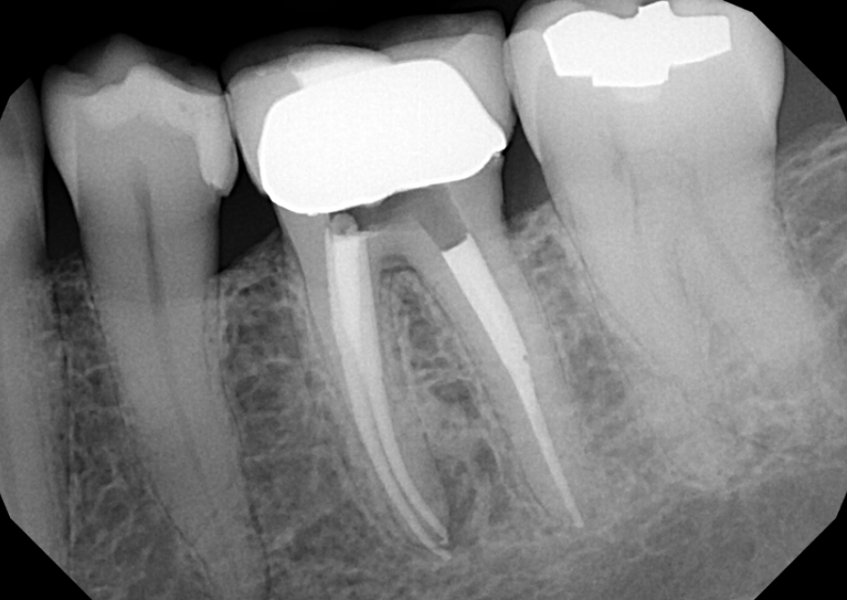After treatment - Retreatment #19