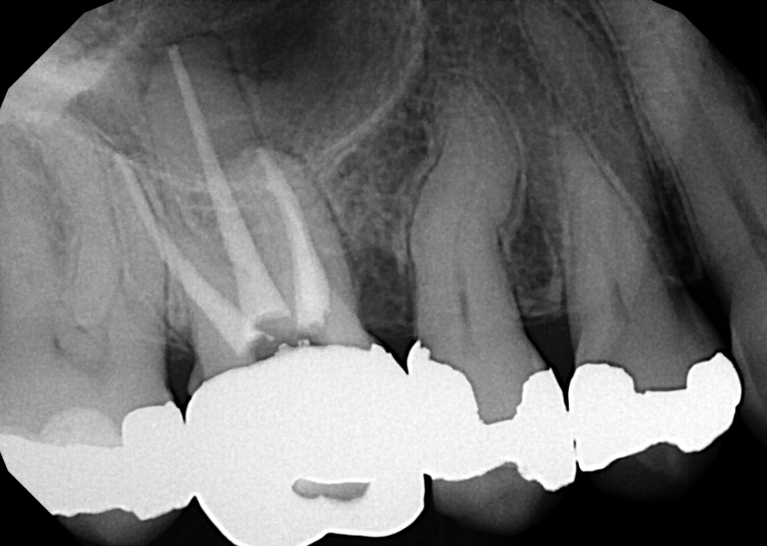 After treatment - Retreatment #3