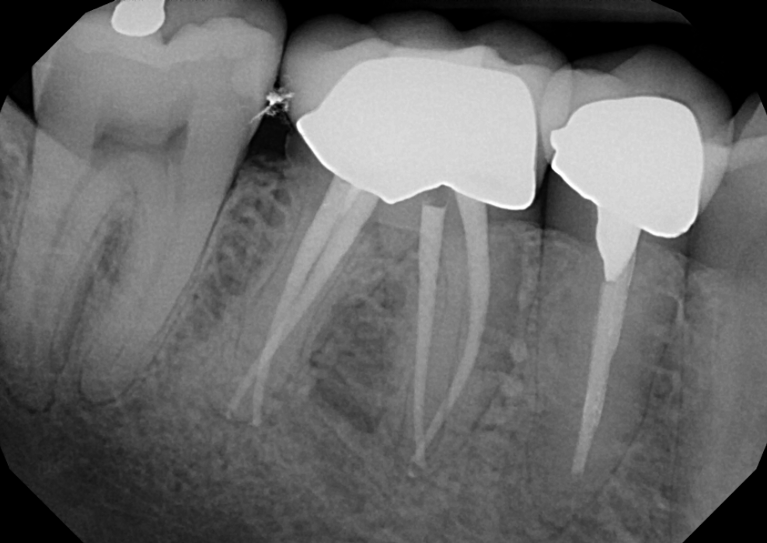 After treatment - Root Canal Treatment #30