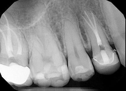 After treatment - Root Canal Treatment #5