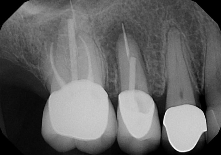 Before treatment - Endodontic Surgery (Apicoectomies) #4