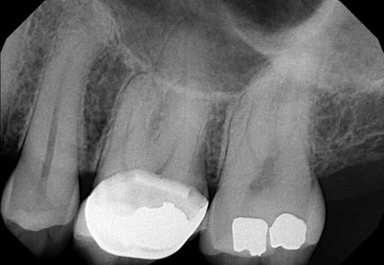 Before treatment - Root Canal Treatment #14
