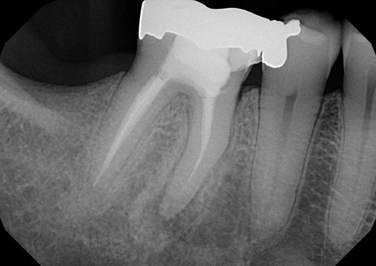 Before treatment - Endodontic Surgery (Apicoectomies) #30