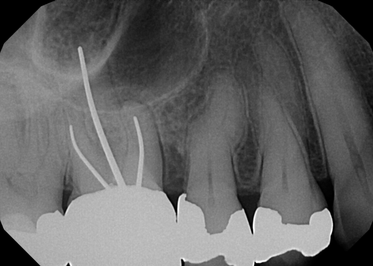 Before treatment - Retreatment #3