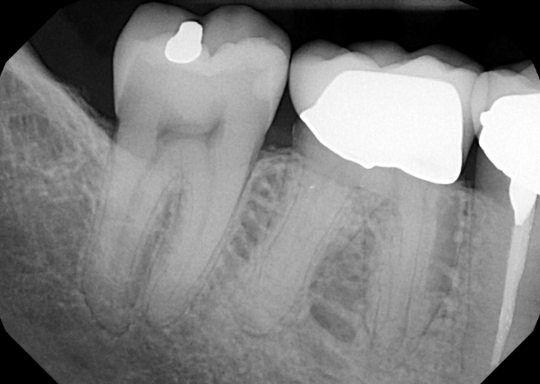Before treatment - Root Canal Treatment #30