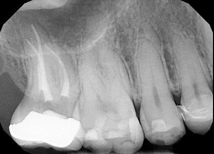 Before treatment - Root Canal Treatment #5